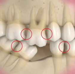 Tooth and Bone Loss