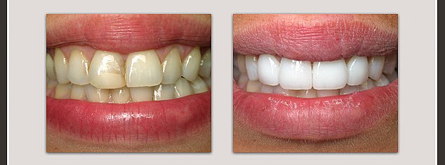Teeth Whitenin
