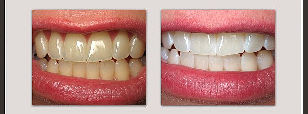 Teeth Whitenin