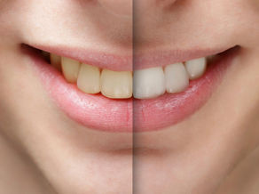 A patient’s smile before and after a teeth whitening procedure