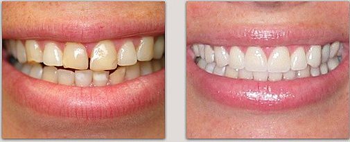 before and after restorative dentistry