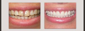 before and after smile makeover