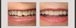 before and after dental bonding