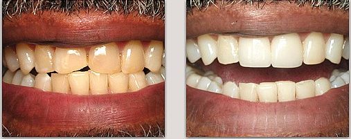 before and after dental treatment