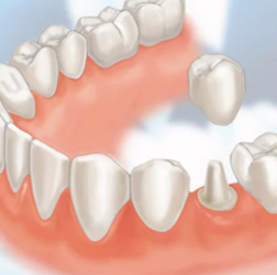 a dental crown
