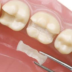 dental inlay