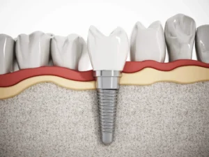 Illustration showing dental implants in Farmington Hills, MI.