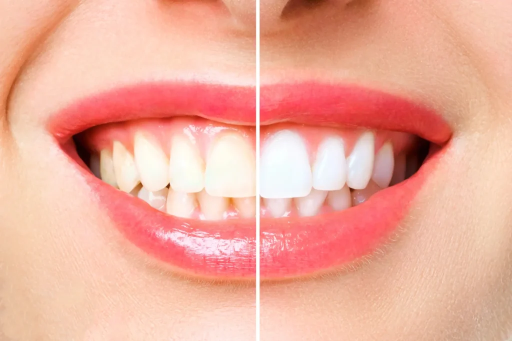 Before and After Teeth Whitening Farmington Hills MI