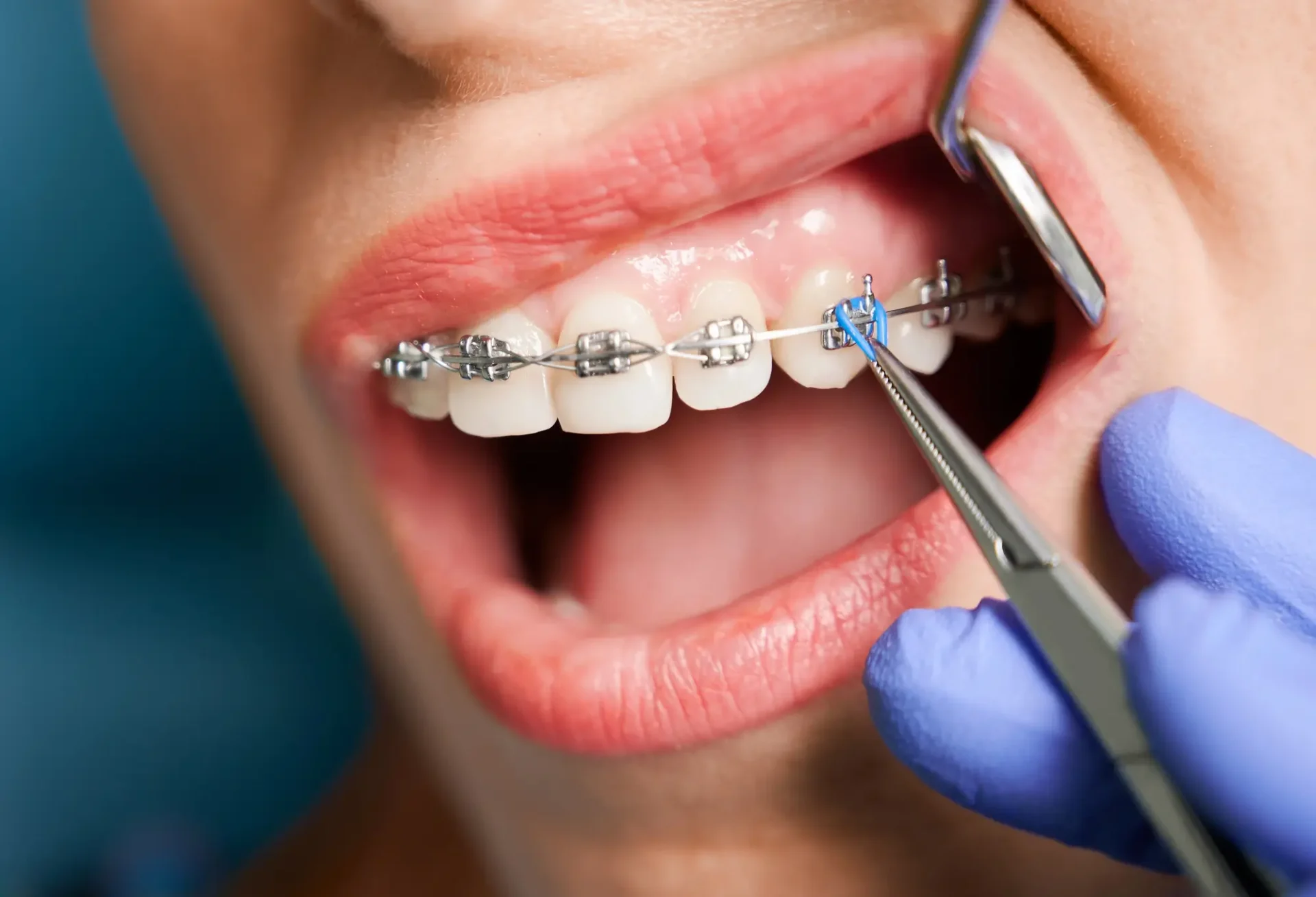 Orthodontic Treatment with Clear Aligners Farmington