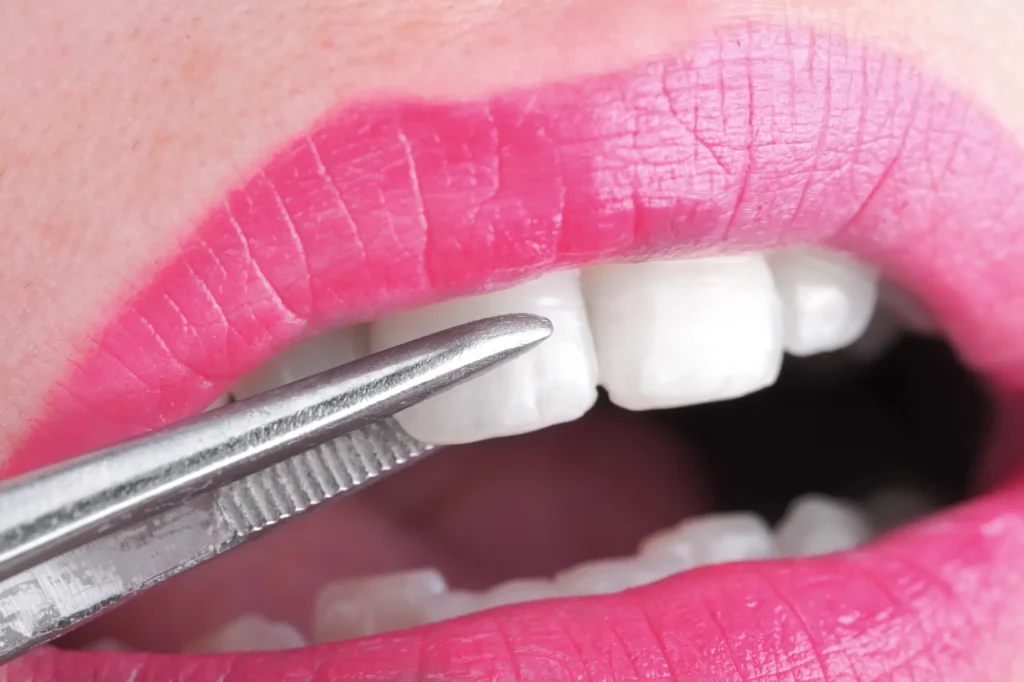 Dental Exam for Lumineers® in Farmington Hills